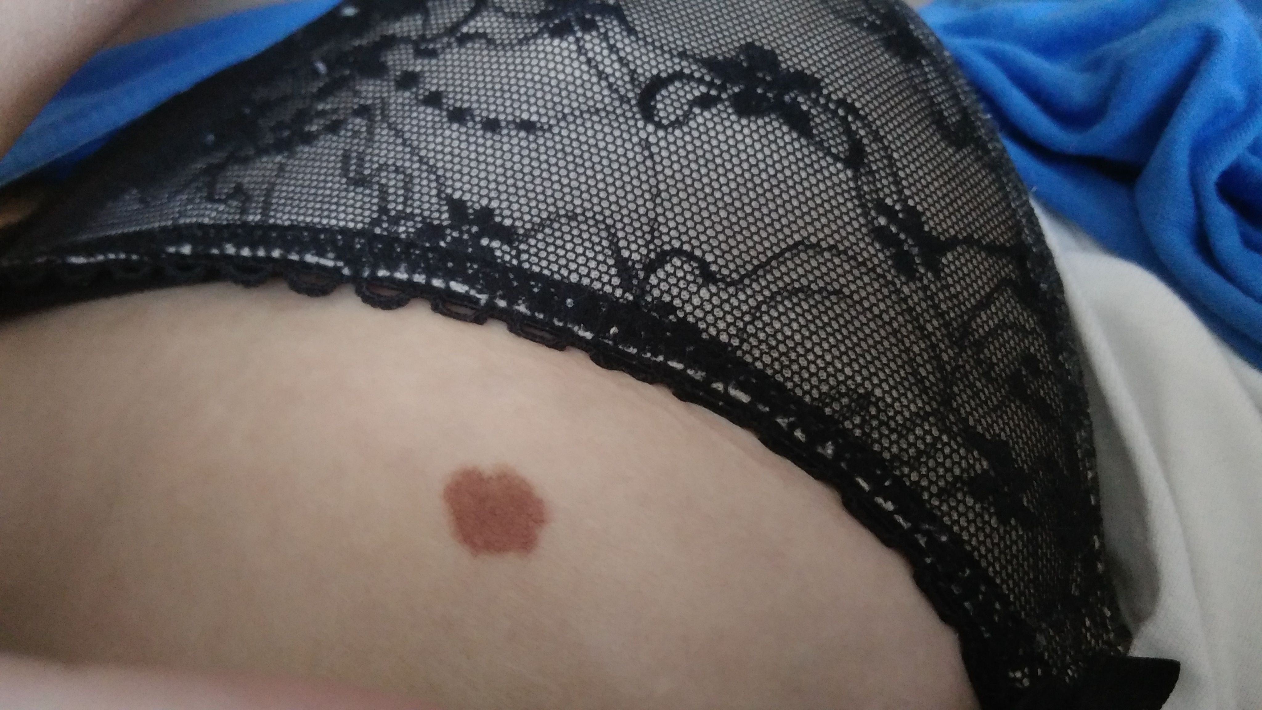 черные точки на груди у женщин фото 106