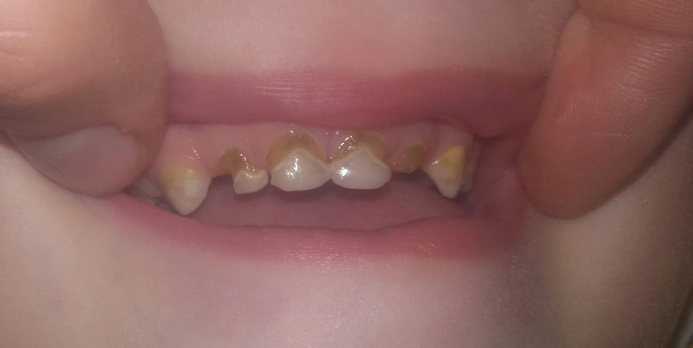 Как сохранить такие зубы до смены?
