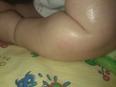 Девочки что может быть пятношко шыршавое, мы на гв зубов у нас еще нет, спим плохо давала дантинорм беби могла быть побочка? На…