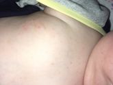 Потничка или аллергия ?