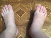 Отеки