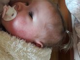 Диатез/аллергия/дерматит у малышки?