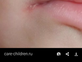 Простуда на губах