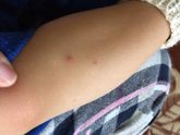 Красные прыщики на теле у ребёнка