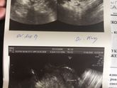 Выход двух яйцеклеток в одну овуляцию