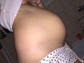 Живот и шов после КС