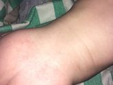 Девочки!!! S O S!! Аллергия?! Потница?! У меня паника