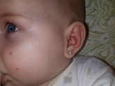 У дочки прыщики