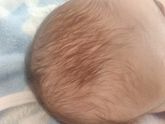 Гнойнички на голове