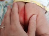 Посоветуйте пожалуйста чем мазать,