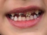 Зайдите те для кого актуален этот вопрос❗️❗️Наращивание зубов детям до 3 лет❗️