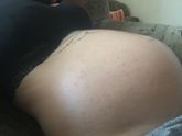❌ алергия ? Предвестники расстяжек ? Чешется ужас