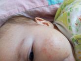 Аллергия？или цветение？на теле ничего