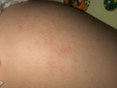 Потничка/аллергия/крапивница