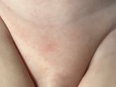 Аллергия или раздражение