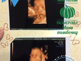 3 скрининг, двойняшки👶🏻👶🏻❤️