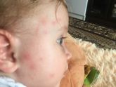 Чем помазать укусы от комаров?