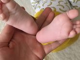 Образования на ступнях.