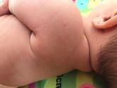 Аллергические высыпания могут пройти за один день?