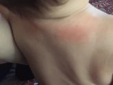 Сыпь