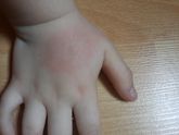 Укус мошки или клеща?