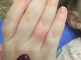 Что это ? Грешу на аллергию от сладкого