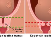 Шейка и утрожестан