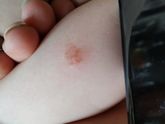 Болячка на руке у ребенка