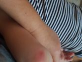 Покраснение на локте