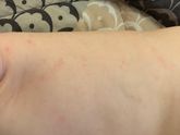 Потница или аллергия?