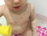 Сыпь по телу