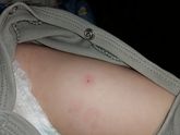 Реакция на АКДС???
