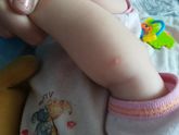 укусы или аллергия?