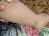 Шершавые пятнышки