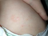 Аллергия или потница