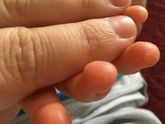 Сухие пальцы рук у ребенка