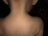 потничка или аллергическая реакция?