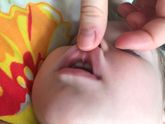 Дочь упала и порвала уздечку! Что делать ?