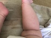 Что за сыпь??