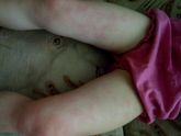 Мазь календулы и атопический дерматит