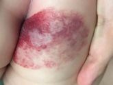 Язвы на гемангиоме, чудо средство Cellgel, НЕ РЕКЛАМА(фото всех средств и язв прилагается)