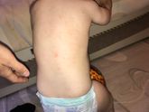 Потничка или аллергия?