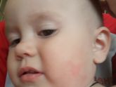 Девчат это что аллергия? Никогда не вылазила на щеке. Нам 1.6. Может ли быть на персик? И что дать и чем помазать. Нам в садик …