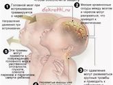 Синдром детского сотрясения