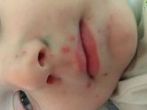 У кого была ветрянка, зайдите пожалуйста