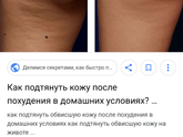Обвисш.кожа на животе и на ляхах после родов.