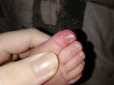 У дочки нарывает пальчик