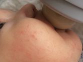 Аллергия на смесь или