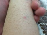 Кожа на ногах