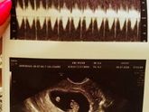 Беременность & 2,3 УЗИ 🤰🏼🎥